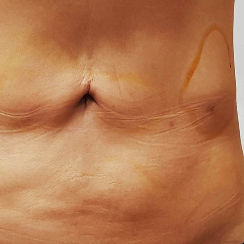 복부 심한 유착