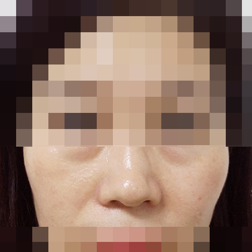 광대 돌출과 울퉁불퉁