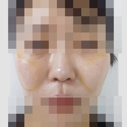 지방이식 후 과생착