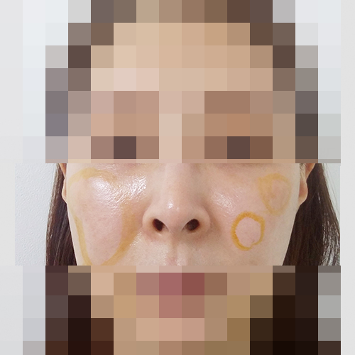 지방이식 후 울퉁불퉁