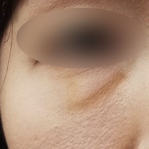 울퉁불퉁한 흉살·섬유조직