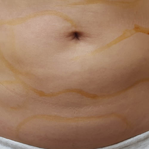 복부지방·울퉁불퉁