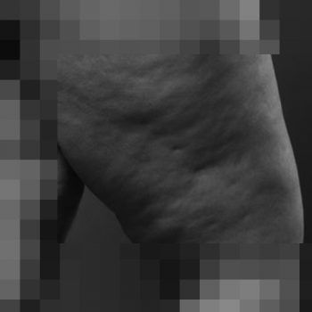 복부·허벅지 셀룰라이트