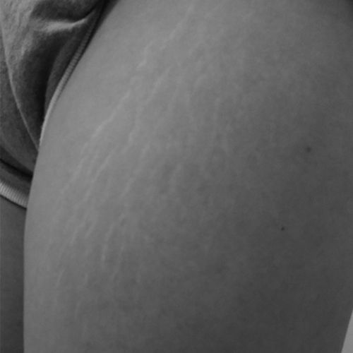 허벅지 흰튼살 — 시술 전